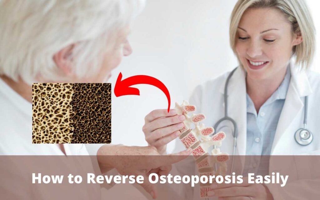 How to Reverse Osteoporosis